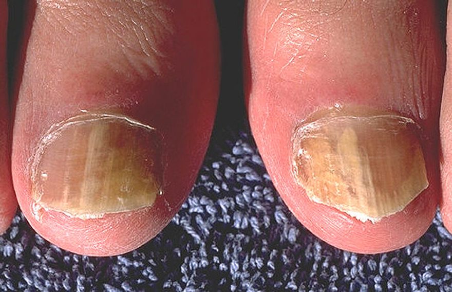 Photograph: onychomycosis of both great toenails, caused by Trichophyton rubrum